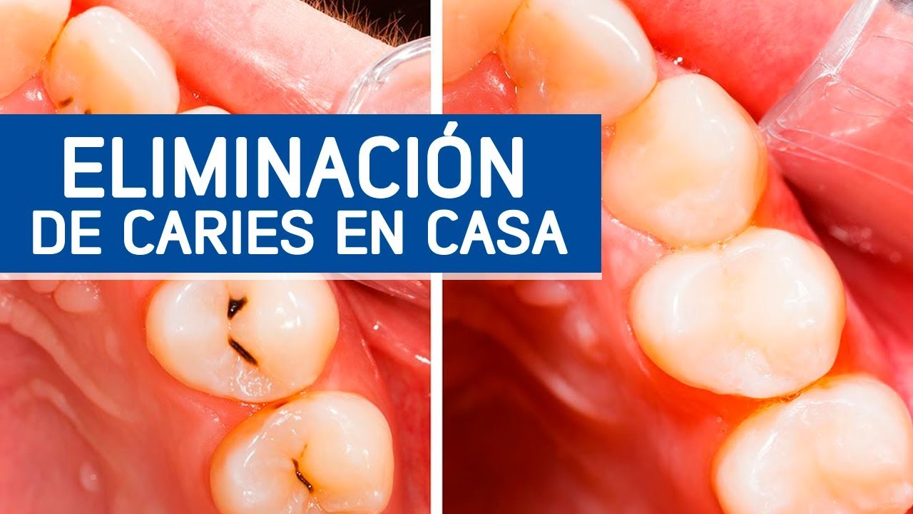 Eliminar caries de forma casera Monse